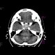 Adenoma of the hypophysis: CT - Computed tomography